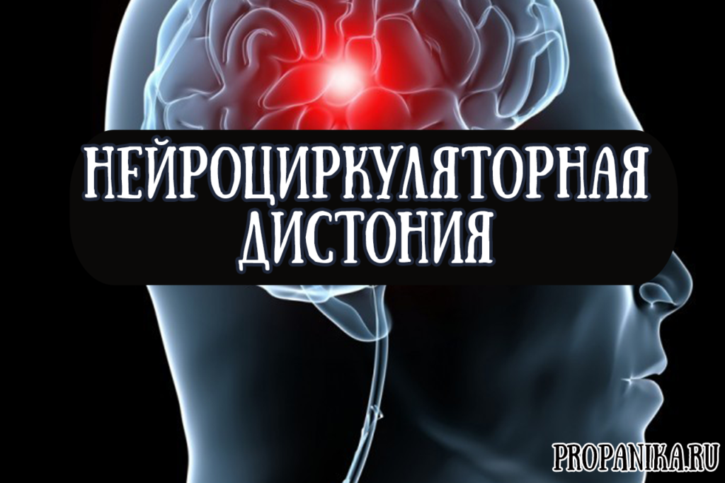 Нейроциркуляторная дистония